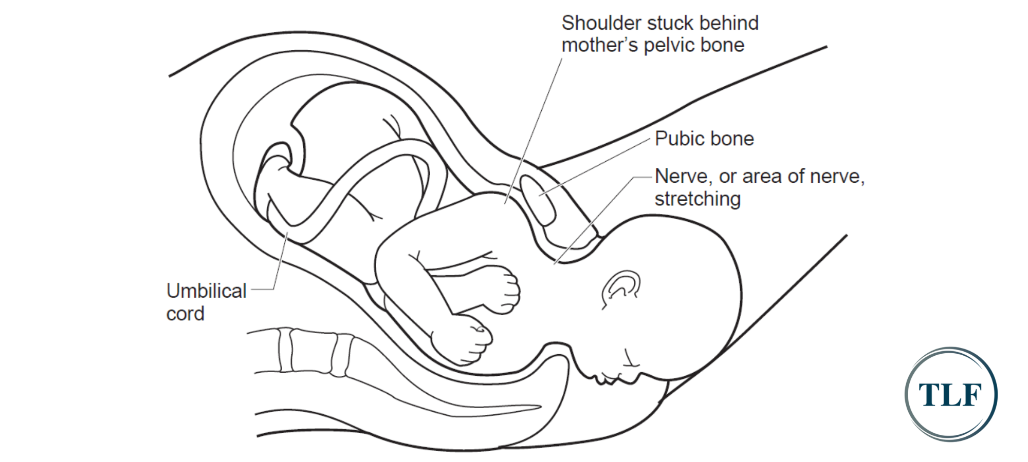 shoulder dystocia malpractice attorneys