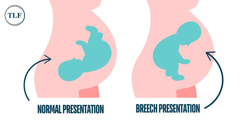 What is Breech Presentation